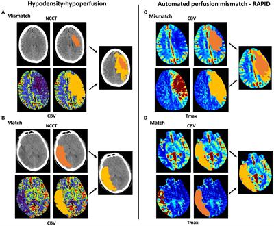 Computed tomography hypoperfusion-hypodensity mismatch vs. automated perfusion mismatch to identify stroke patients eligible for thrombolysis